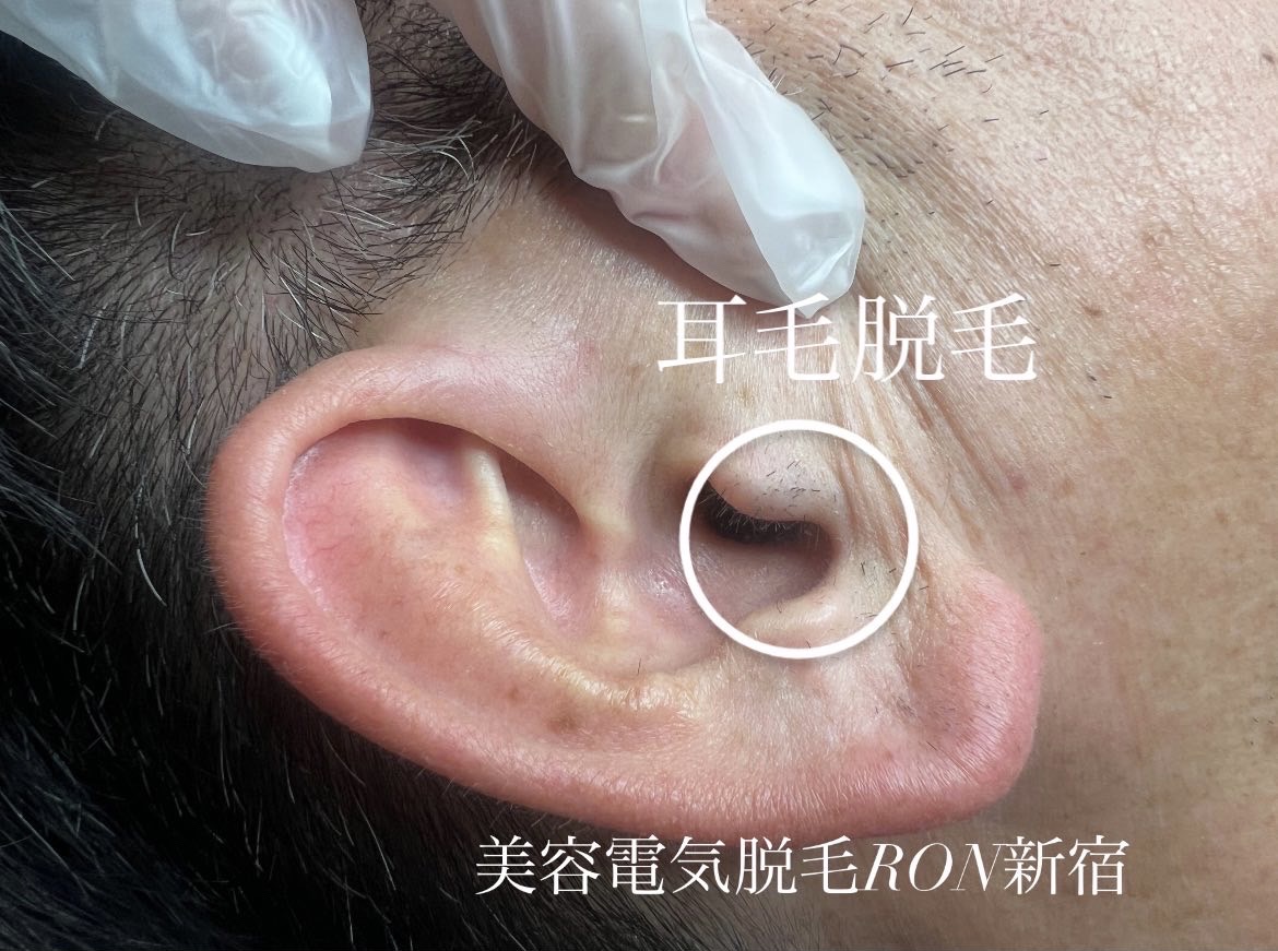 耳毛 耳毛も脱毛できます。 - メンズ脱毛RONブログ - 新宿メンズ脱毛・髭