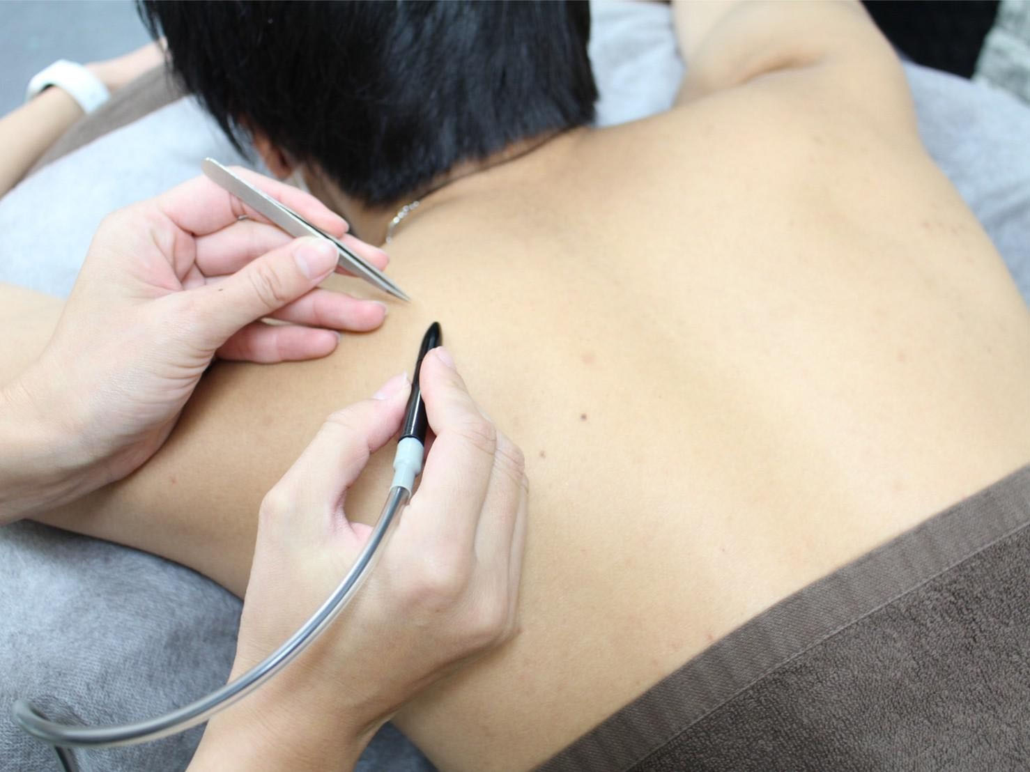 電気脱毛 電気脱毛